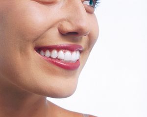 Mit Invisalign Zahnspangen sicher lächeln | Swiss Smile  