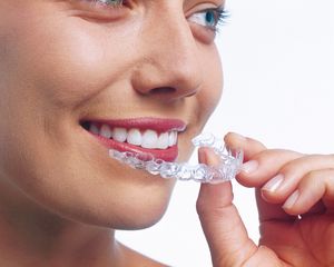 Invisalign Zahnspangen zum Ausrichten der Zähne | Swiss Smile  