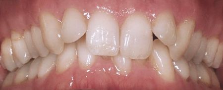 Zähne vor der Verwendung von Invisalign zum Glätten der Zähne | Swiss Smile  