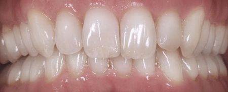 Zähne nach Verwendung von Invisalign-Ergebnissen zur Zahnkorrektur | Swiss Smile  