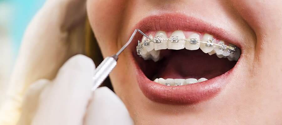 Need of dental braces and its types | Swiss Smile 